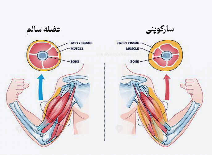 سارکوپنی چیست؟ +راهکارهای پیشگیری